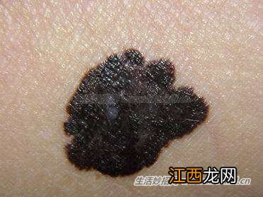 反复用激光除痣,恐有癌变!