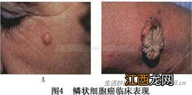 反复用激光除痣,恐有癌变!