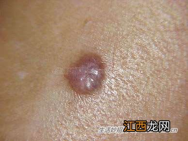 反复用激光除痣,恐有癌变!