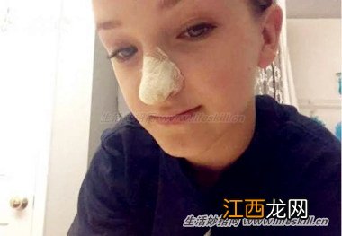 清除“黑头”的简便方法,效果很明显哦~