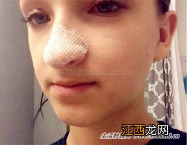 清除“黑头”的简便方法,效果很明显哦~