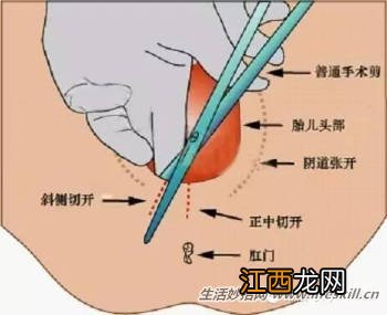 会阴侧切:顺产妈咪要知道的事!
