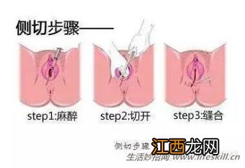 会阴侧切:顺产妈咪要知道的事!