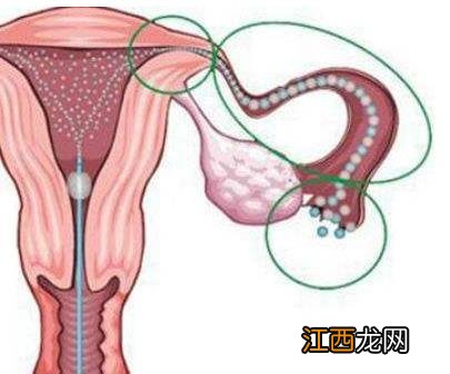 输卵管妊娠的自我检查、症状及治疗方法