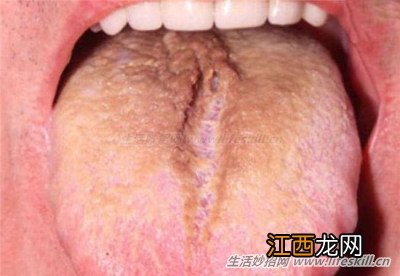 刷牙时看看舌头，这9种状态预示着不同的疾病！