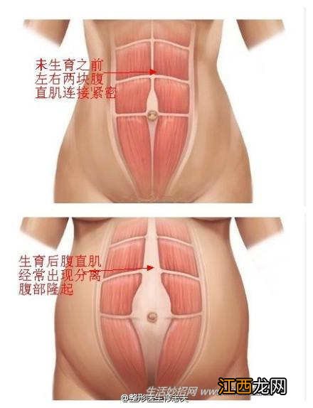 怎么让“水桶腰”恢复成“小蛮腰”？