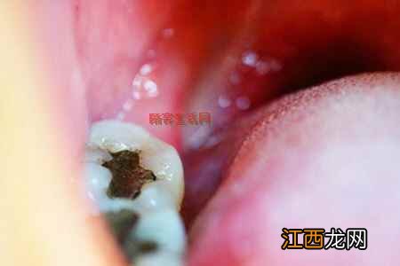 牙肉肿痛是什么原因造成的？这五个牙龈肿大的原因引起的