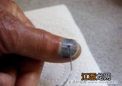 指甲受伤造成大面积瘀血该怎么处理?