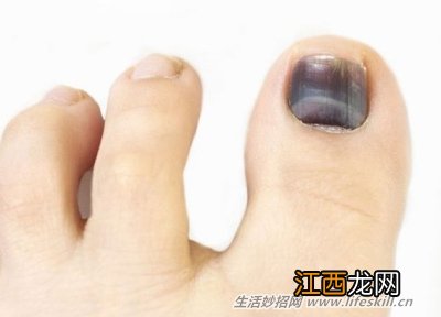 指甲受伤造成大面积瘀血该怎么处理?