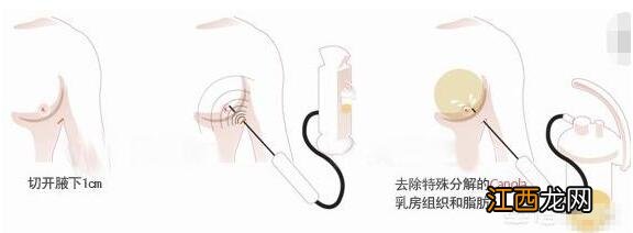 如何做缩胸手术的方法