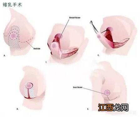 如何做缩胸手术的方法