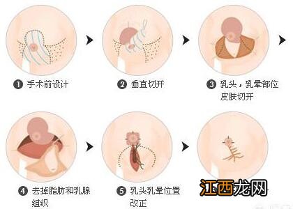 如何做缩胸手术的方法