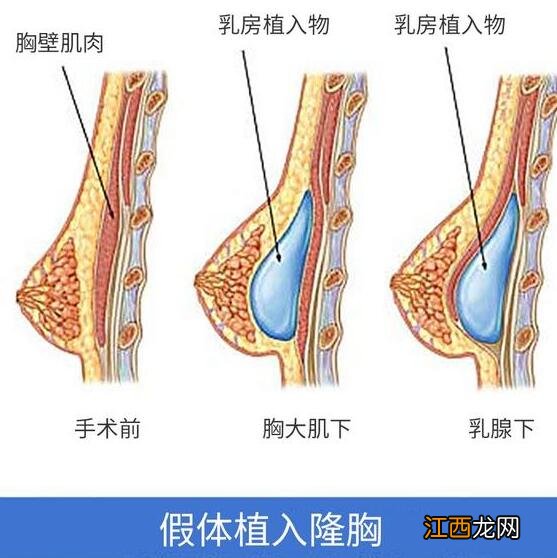 假体隆胸的危害有哪些？