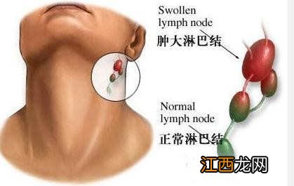 淋巴结肿大怎么消除 4种方法治疗淋巴结肿大