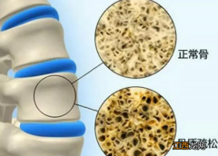 什么是骨质疏松？水煮蛋会引起骨质疏松？