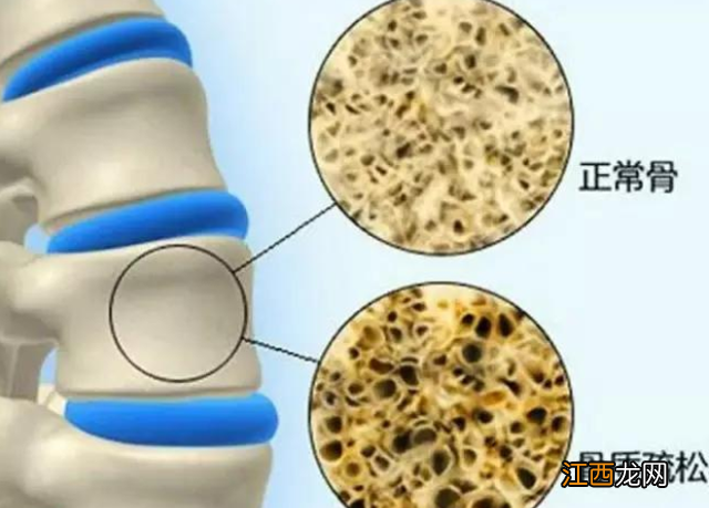 什么是骨质疏松？水煮蛋会引起骨质疏松？