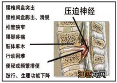 腰椎间盘突出，6方面教你自我判断严重程度！