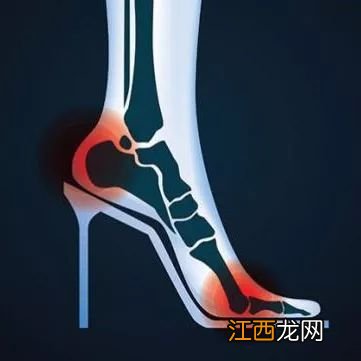 拇指外翻有何危害和表现?