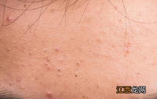 正确处理黑头 弄清楚每个部位长黑头的原因