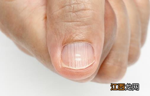 指甲凹陷的日常护理方法 指甲与疾病的预测关系