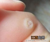 治疗鸡眼的小偏方