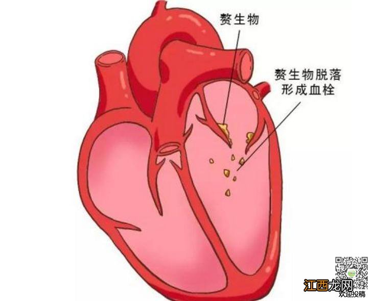 为什么会心脏血管堵死-心脏血管堵塞怎么办