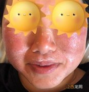 图 深圳一小姐姐为卸妆涂抹“网红神器”椰子油，脸肿致无法睁眼