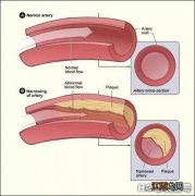 保护血管，建议您多吃三类食物 保护血管多吃这四种食物