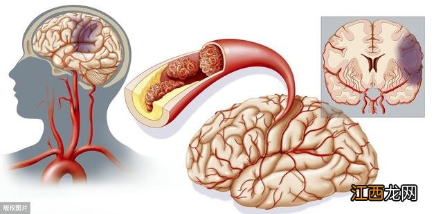 脑梗塞吃什么药？脑梗塞日常吃什么，特别好的文章