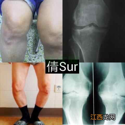 关节肿胀、变形,坚持跑步、运动的你,膝关节还行吗?