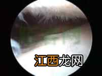 关节肿胀、变形,坚持跑步、运动的你,膝关节还行吗?