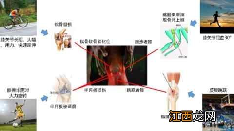 关节肿胀、变形,坚持跑步、运动的你,膝关节还行吗?