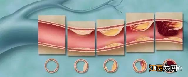 颈动脉硬化吃什么食物好？颈动脉硬化吃点啥，实在太有用了