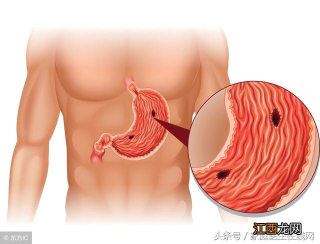 爱吃生冷食物导致胃溃疡？胃溃疡能吃生冷水果吗，原来诀窍这么简单