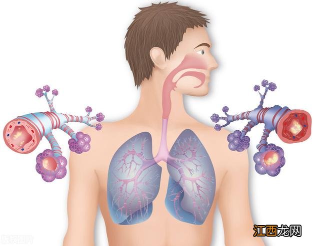 干性支扩和湿性支扩哪种更严重？轻度支扩最佳治疗方法，经验之谈，非常有用