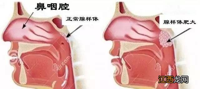 鼻咽炎有什么食疗方法？鼻咽炎要吃什么，请认真看完这篇文章