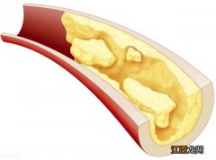 血管硬化吃什么食物好得快？血管硬化的五种食物，科普大咖来了！