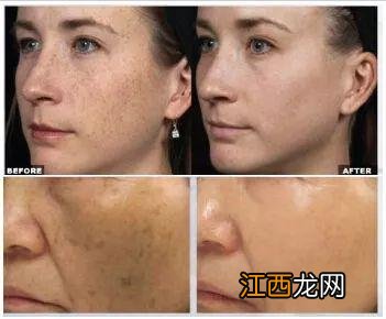 用什么药膏可以去除晒斑?脸上晒斑淡斑最好的土办法,这几个点值得思考