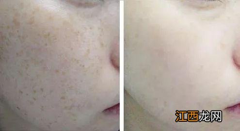 用什么药膏可以去除晒斑?脸上晒斑淡斑最好的土办法,这几个点值得思考