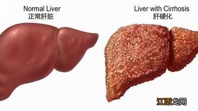 肝硬化病人用什么油做菜比较好？肝硬化能吃油吗，还不快学学