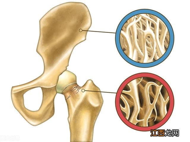 什么是骨质疏松？骨折的五种类型，看这里就知道了