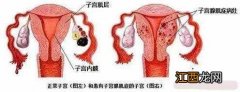 百年偏方七天治疗腺肌症 子宫腺肌症中药方剂及偏方