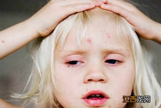 怎么判断是不是水痘 儿童出水痘的症状表现