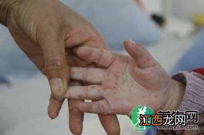 春季警惕手足口病 手足口病的初期症状及常见问题