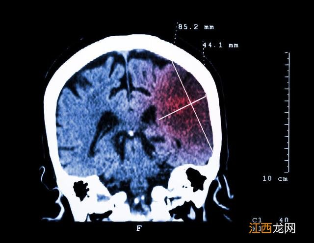 脑梗的人吃什么好 吃什么能预防脑梗塞呢