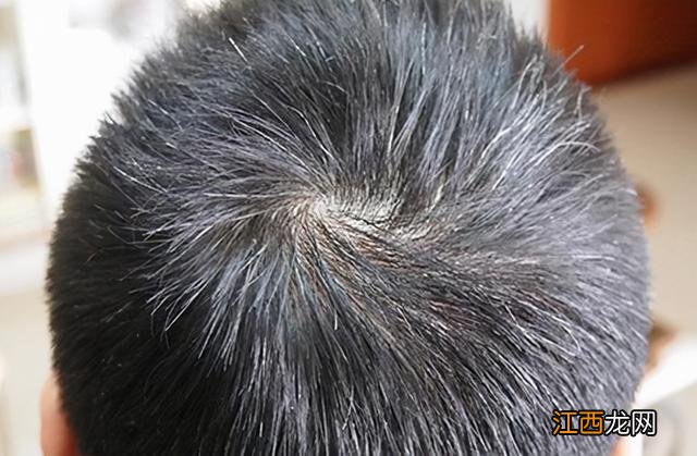 少年有白头发吃什么好?青少年白头发吃什么能改善,关键点在这里