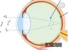 千辛万苦找到6个偏方治疗飞蚊症