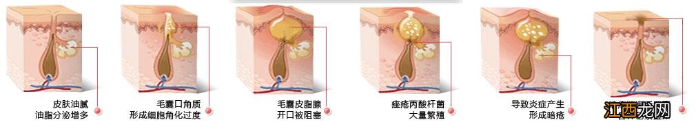 祛痘痘的生活技巧？金银花水祛痘痘，细分详解，看此文