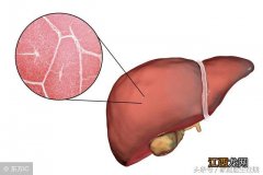 肝炎需要忌口什么？肝炎的禁忌食物，秘诀告诉你，在这里
