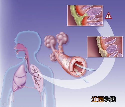 气管炎咳嗽吃什么药最有效 支气管炎吃什么能好